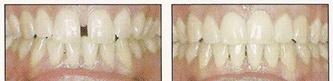歯と歯の隙間